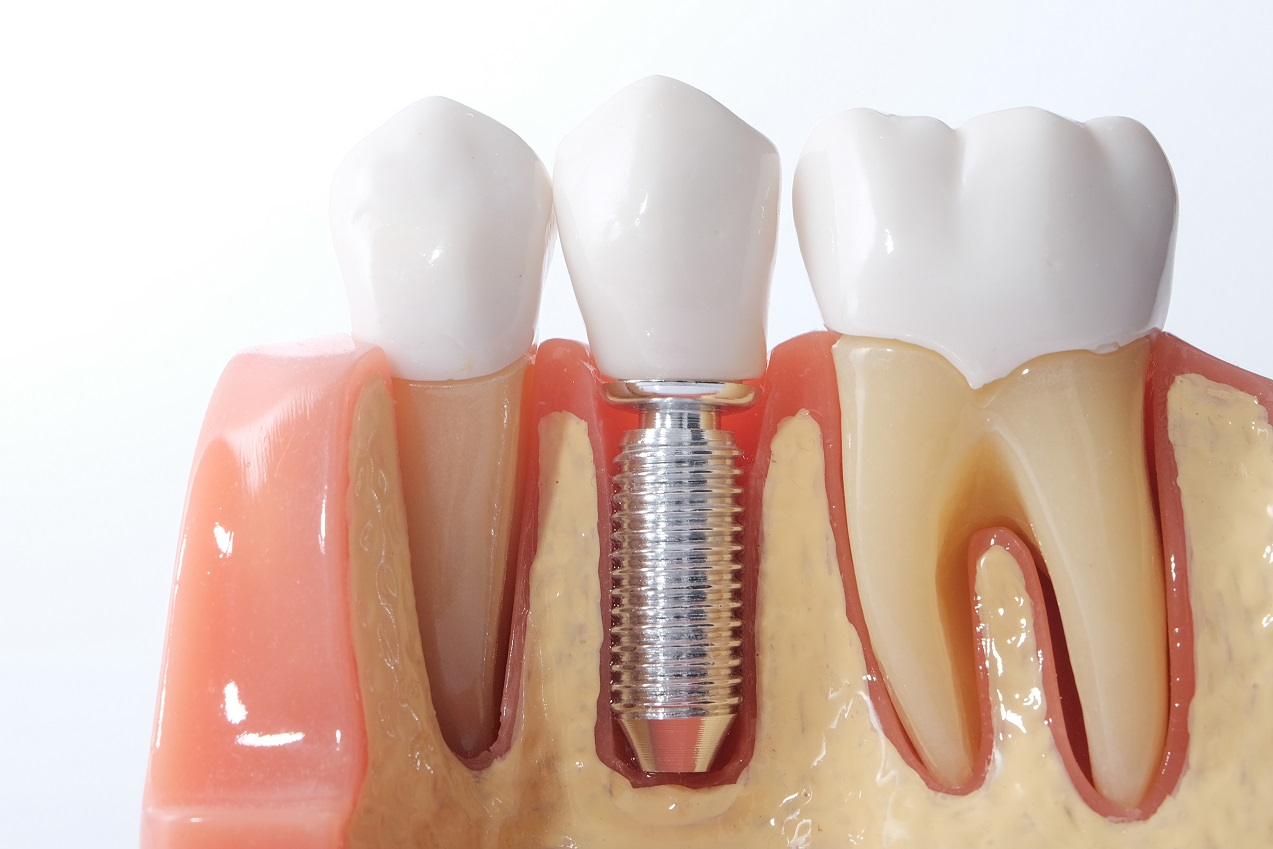 Всё, что нужно знать о зубных имплантах: основные преимущества и виды